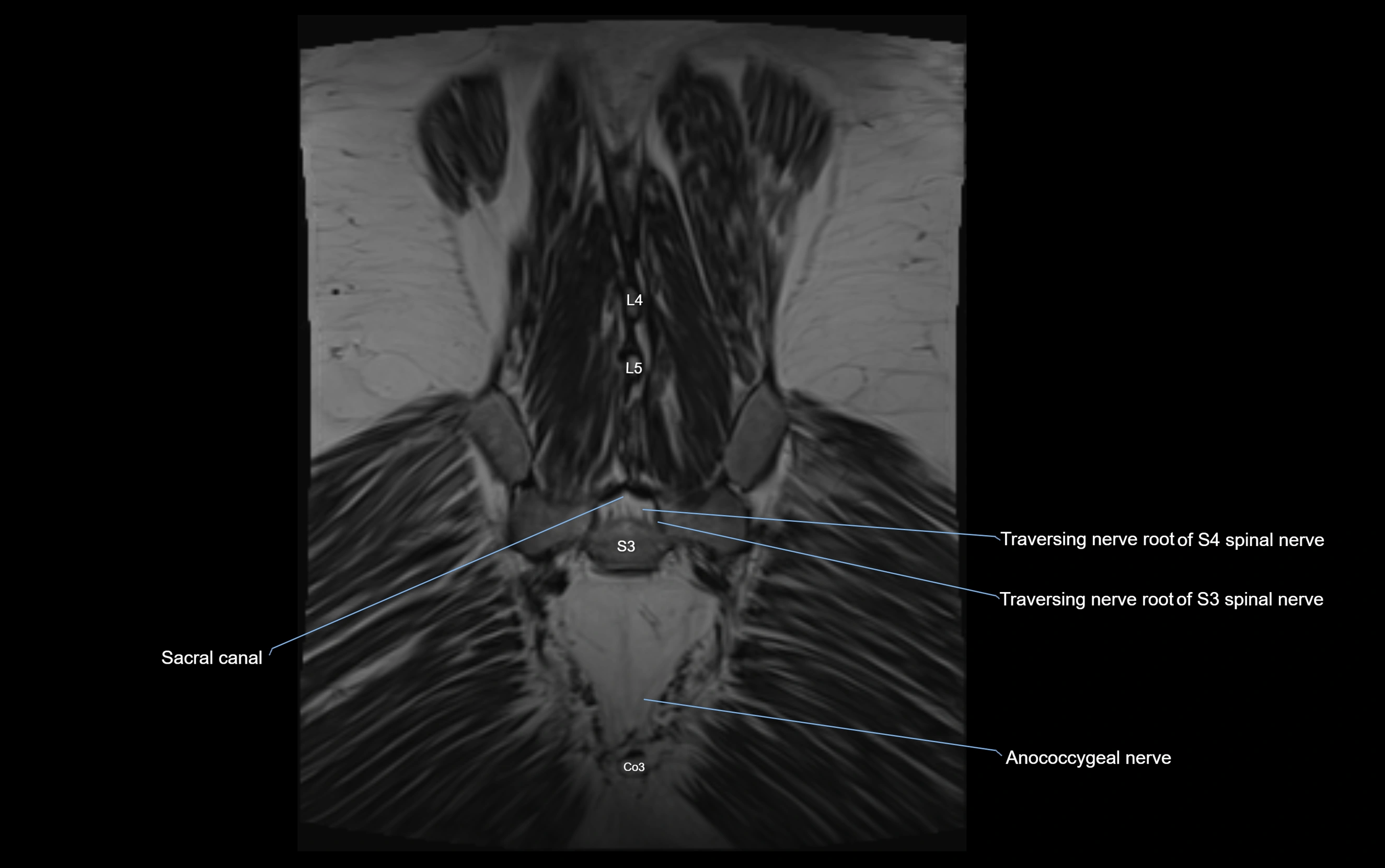 MR lumbosacral plexus cross sectional anatomy 3T  radiology  image-img-09001-00074.webp
